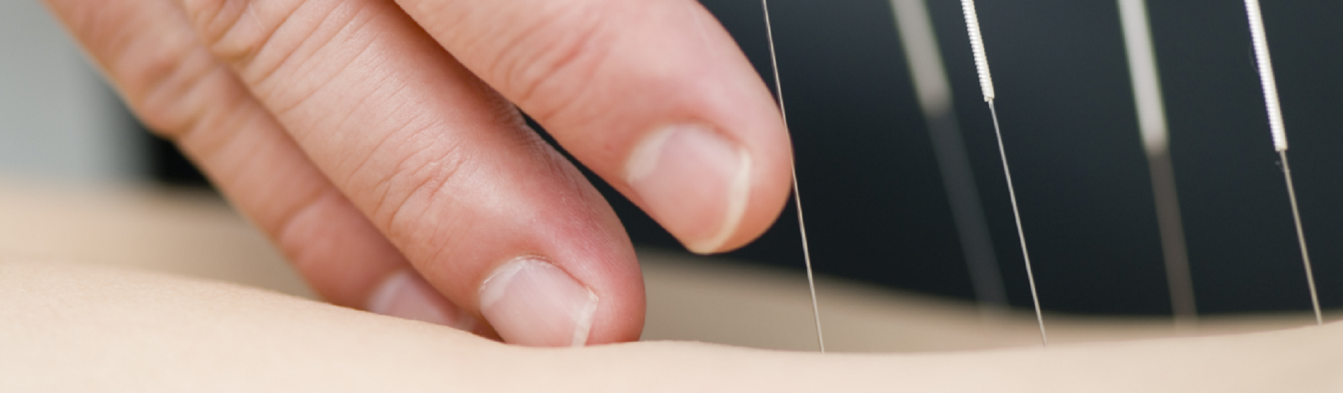 Aiguilles d'acupuncture 